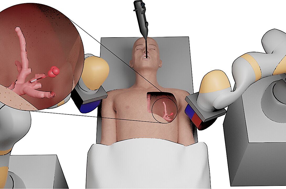 VIDEO. Cancerul pulmonar, tratat de un mini robot. Cum arată dispozitivul dezvoltat de cercetătorii de la Universitatea din Leeds