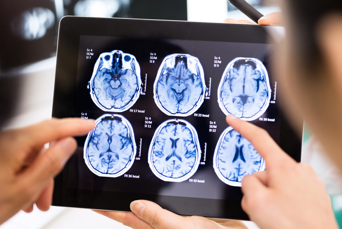 Implanturile cerebrale au reușit să trateze leziuni traumatice