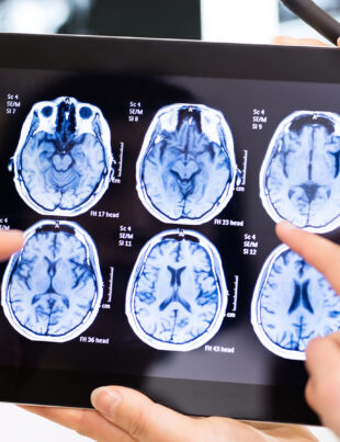 Implanturile cerebrale au reușit să trateze leziuni traumatice