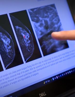 Specialiștii caută un nou tratament pentru cancerul de sân