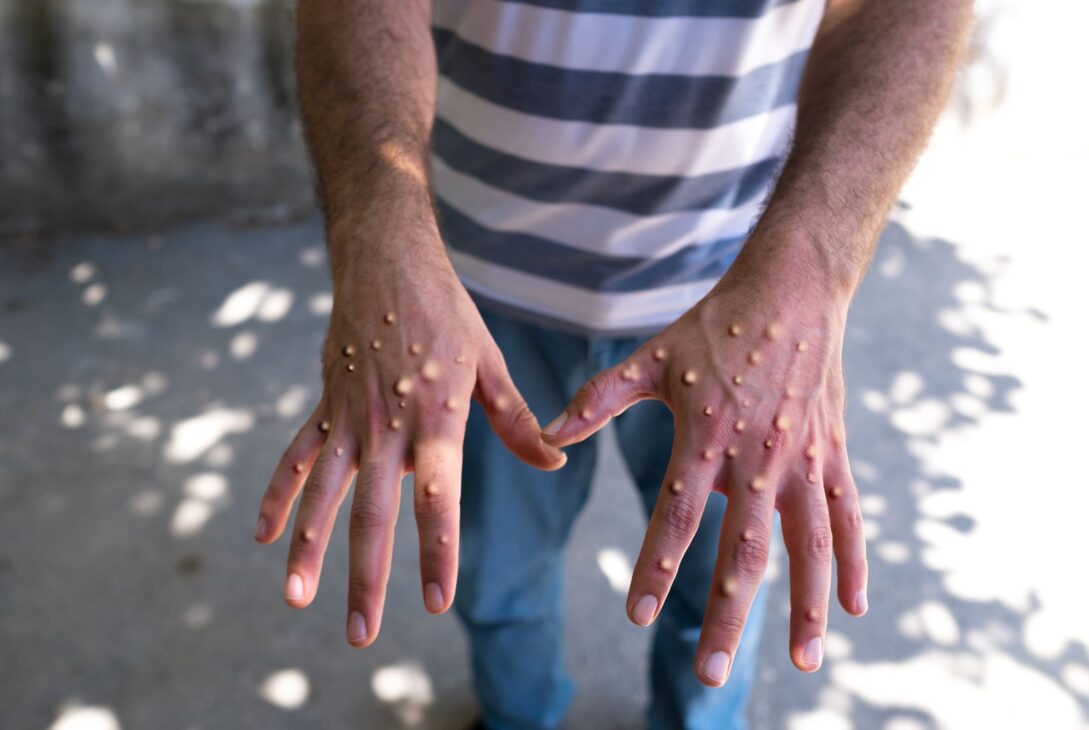 Mpox a ajuns în Europa. Suedia confirmă primul caz