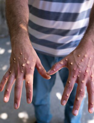 Mpox a ajuns în Europa. Suedia confirmă primul caz