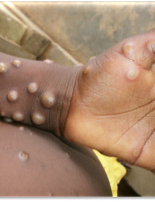 Pakistan a confirmat un caz de virus mpox