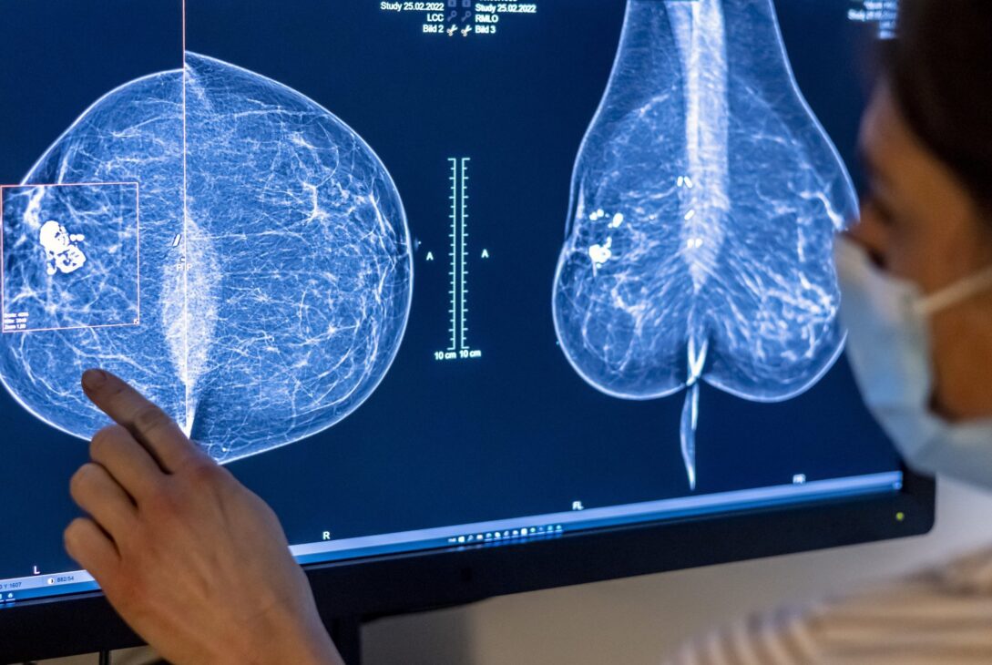 Inteligența artificială îmbunătățește predicția cancerului mamar