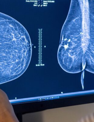 Inteligența artificială îmbunătățește predicția cancerului mamar
