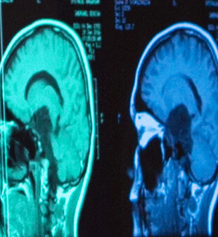 Cercetătorii propun un nou tratament pentru metastazele cerebrale
