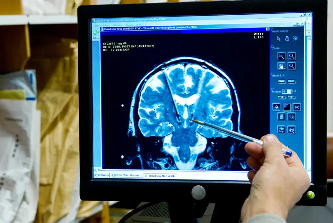 A.I. decodează gândurile în vorbire pentru pacienții AVC​
