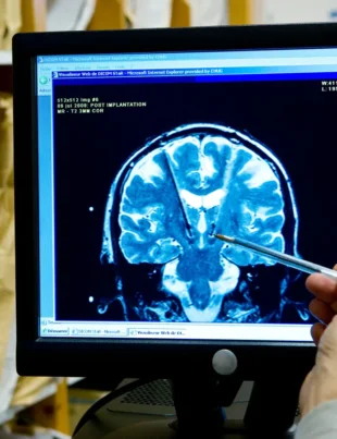 A.I. decodează gândurile în vorbire pentru pacienții AVC​