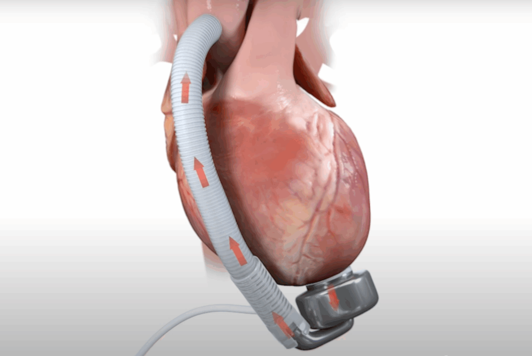 Prima pompă cardiacă cu membrană ondulată a fost implantată