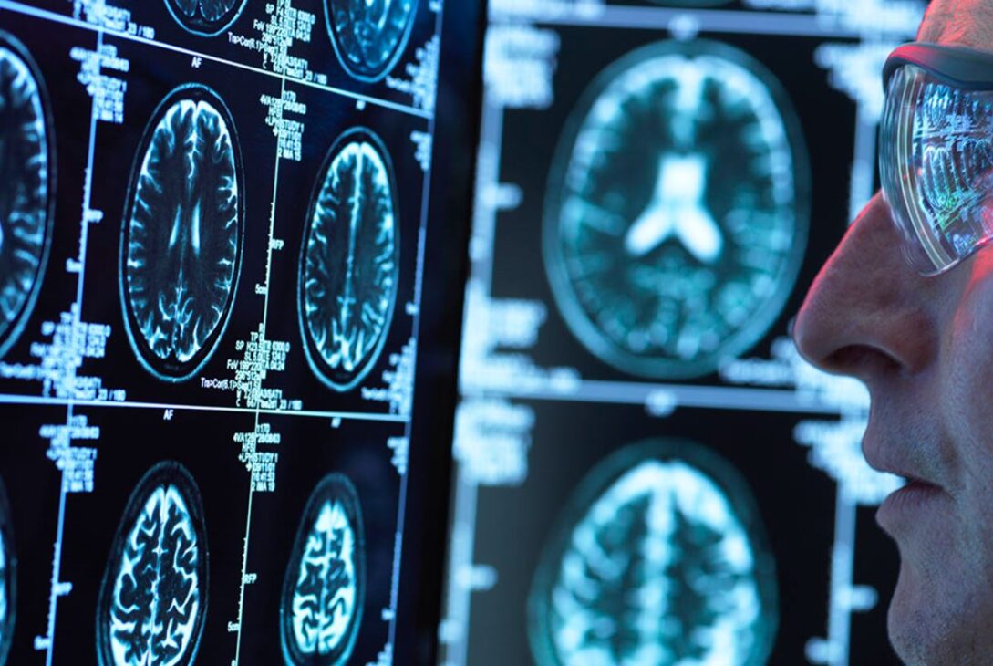Litiul poate proteja creierul de îmbătrânirea cauzată de Alzheimer